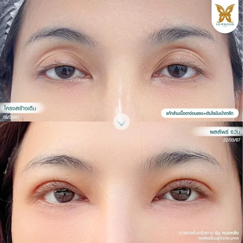 ภาพรีวิวเปรียบเทียบผลลัพธ์ ก่อนทำ-หลังทำศัลยกรรมแก้กล้ามเนื้อตาอ่อนแรง เติมไขมันเบ้าตาลึก โดยอ.หมอหลิง บีพราวด์คลินิก