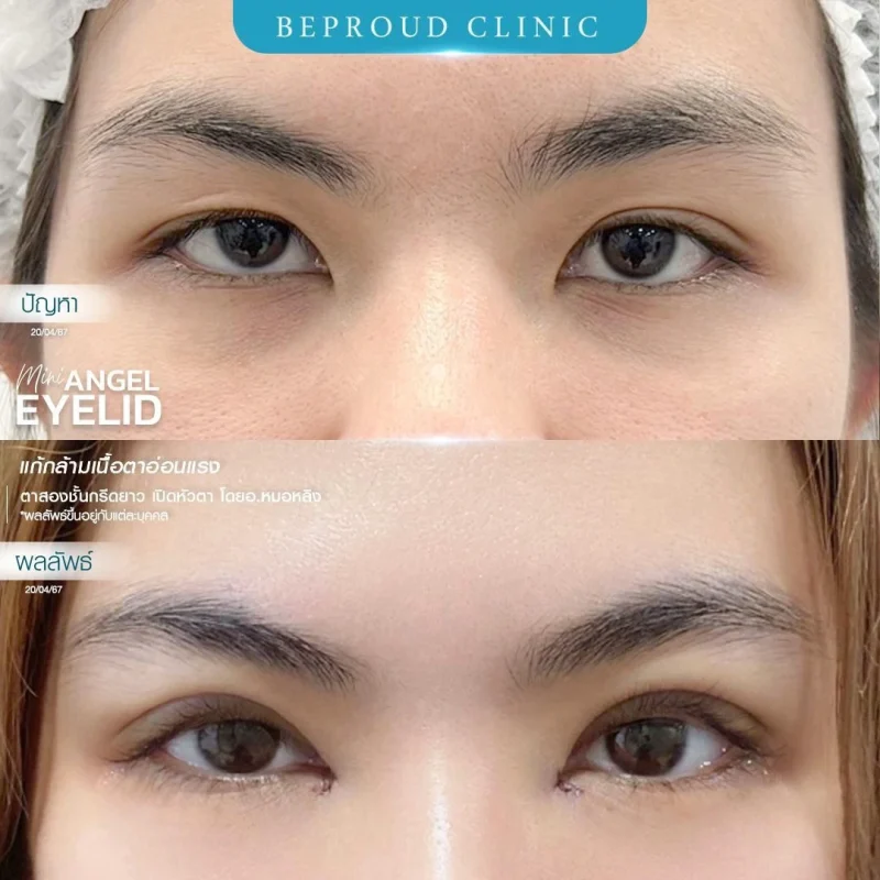 ภาพรีวิวเปรียบเทียบผลลัพธ์ ก่อนทำ-หลังทำศัลยกรรมตาสองชั้น ของเคสตัวอย่าง เทคนิคกรีดตายาว แก้กล้ามเนื้อตาอ่อนแรง เปิดหัวตา โดยอ.หมอหลิง บีพราวด์คลินิก