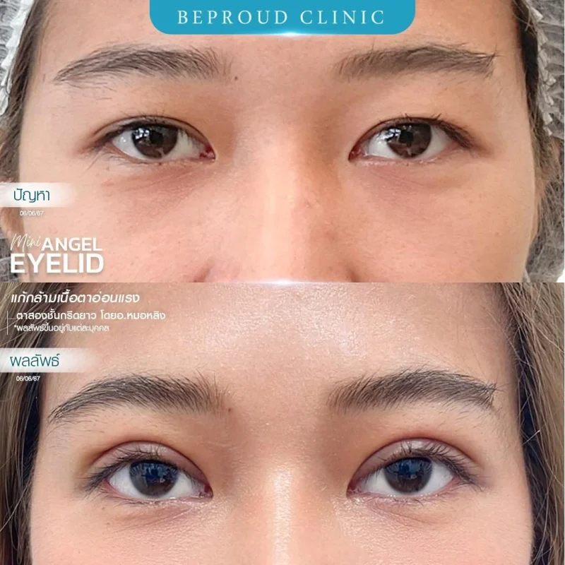 ภาพรีวิวเปรียบเทียบผลลัพธ์ ก่อนทำ-หลังทำศัลยกรรมตาสองชั้น ของเคสตัวอย่าง เทคนิคกรีดตายาว แก้กล้ามเนื้อตาอ่อนแรง โดยอ.หมอหลิง บีพราวด์คลินิก