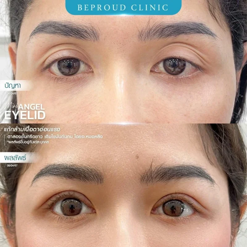 ภาพรีวิวเปรียบเทียบผลลัพธ์ ก่อนทำ-หลังทำศัลยกรรมตาสองชั้น ของเคสตัวอย่าง เทคนิคกรีดตายาว แก้กล้ามเนื้อตาอ่อนแรง เติมไขมันก้นกบ โดยอ.หมอหลิง บีพราวด์คลินิก