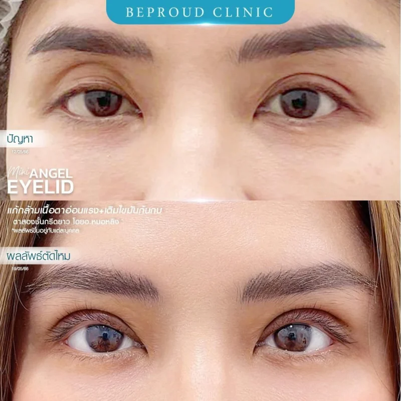 ภาพรีวิวเปรียบเทียบผลลัพธ์ ก่อนทำ-หลังทำศัลยกรรมตาสองชั้น ของเคสตัวอย่าง เทคนิคกรีดตายาว แก้กล้ามเนื้อตาอ่อนแรง เติมไขมันก้นกบ โดยอ.หมอหลิง บีพราวด์คลินิก