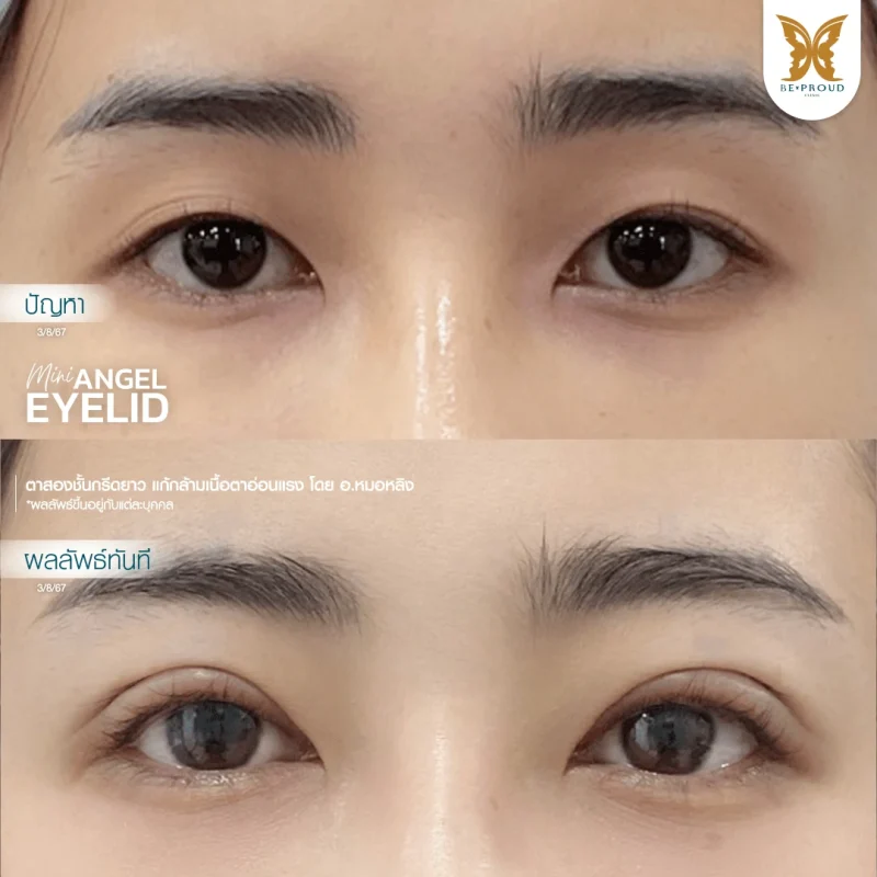 ภาพรีวิวเปรียบเทียบผลลัพธ์ ก่อนทำ-หลังทำศัลยกรรมตาสองชั้น ของเคสตัวอย่าง เทคนิคกรีดตายาว แก้กล้ามเนื้อตาอ่อนแรง โดยอ.หมอหลิง บีพราวด์คลินิก