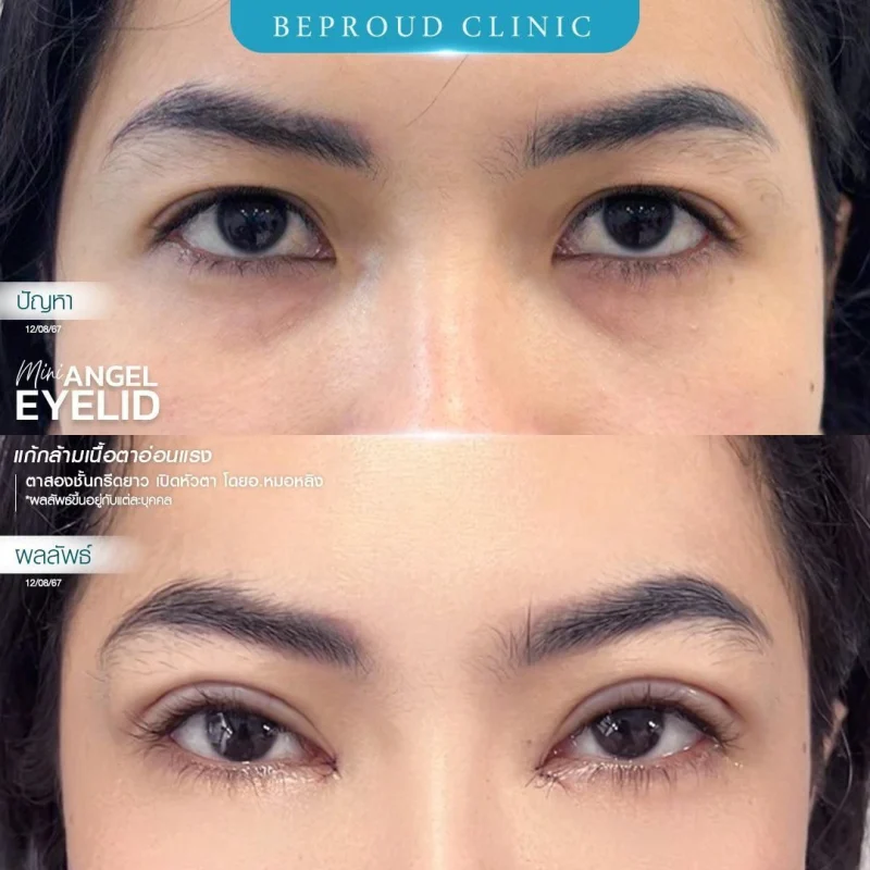 ภาพรีวิวเปรียบเทียบผลลัพธ์ ก่อนทำ-หลังทำศัลยกรรมตาสองชั้น ของเคสตัวอย่าง เทคนิคกรีดตายาว เปิดหัวตา แก้กล้ามเนื้อตาอ่อนแรง โดยอ.หมอหลิง บีพราวด์คลินิก