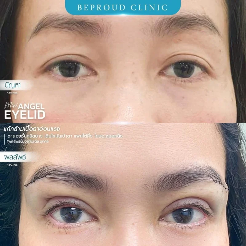 ภาพรีวิวเปรียบเทียบผลลัพธ์ ก่อนทำ-หลังทำศัลยกรรมตาสองชั้น ของเคสตัวอย่าง เทคนิคกรีดตายาว แก้กล้ามเนื้อตาอ่อนแรง เติมไขมันเบ้าตา แผลใต้คิ้ว โดยอ.หมอหลิง บีพราวด์คลินิก