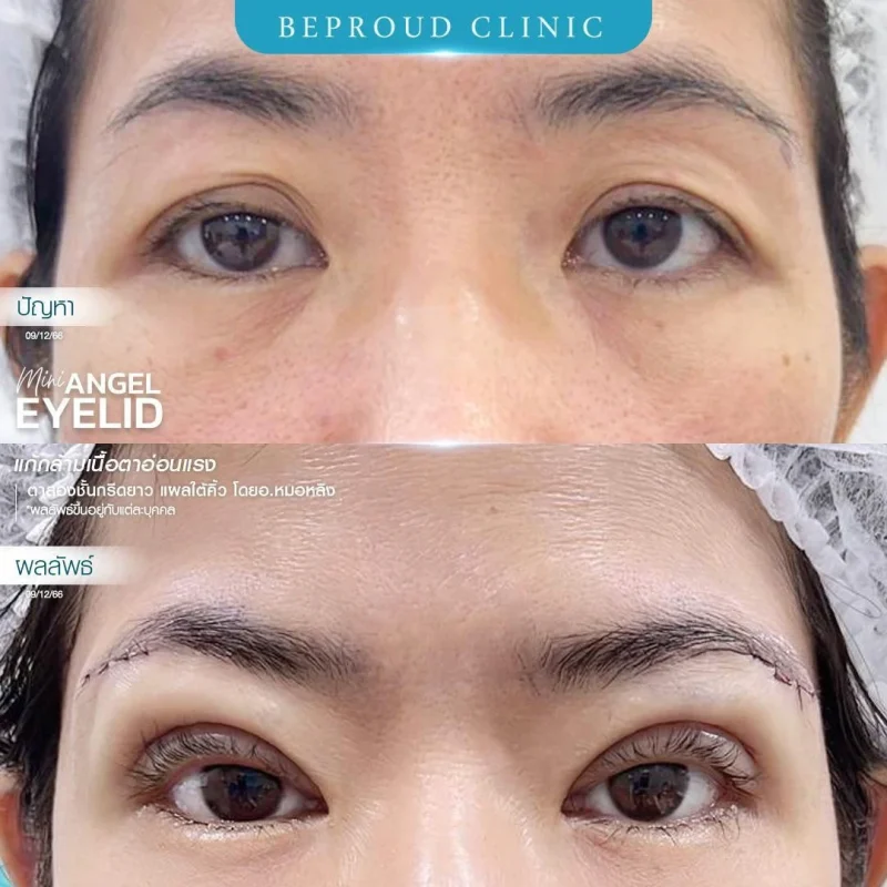 ภาพรีวิวเปรียบเทียบผลลัพธ์ ก่อนทำ-หลังทำศัลยกรรมตาสองชั้น ของเคสตัวอย่าง เทคนิคกรีดตายาว แก้กล้ามเนื้อตาอ่อนแรง แผลใต้คิ้ว โดยอ.หมอหลิง บีพราวด์คลินิก