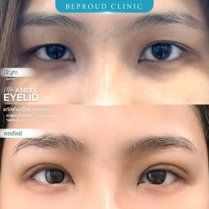 ภาพรีวิวเปรียบเทียบผลลัพธ์ ก่อนทำ-หลังทำศัลยกรรมตาสองชั้น ของเคสตัวอย่าง เทคนิคกรีดตายาว แก้กล้ามเนื้อตาอ่อนแรง โดยอ.หมอหลิง บีพราวด์คลินิก