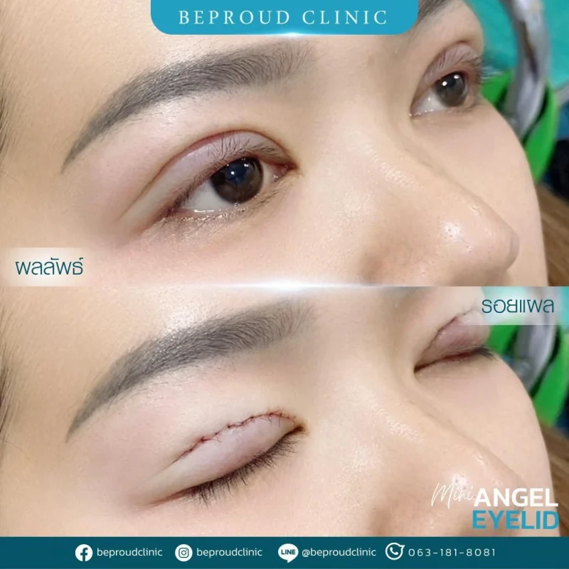 ภาพรีวิวเปรียบเทียบผลลัพธ์ ก่อนทำ-หลังทำศัลยกรรมตาสองชั้น ของเคสตัวอย่าง เทคนิคกรีดตายาว โดยอ.หมอหลิง บีพราวด์คลินิก