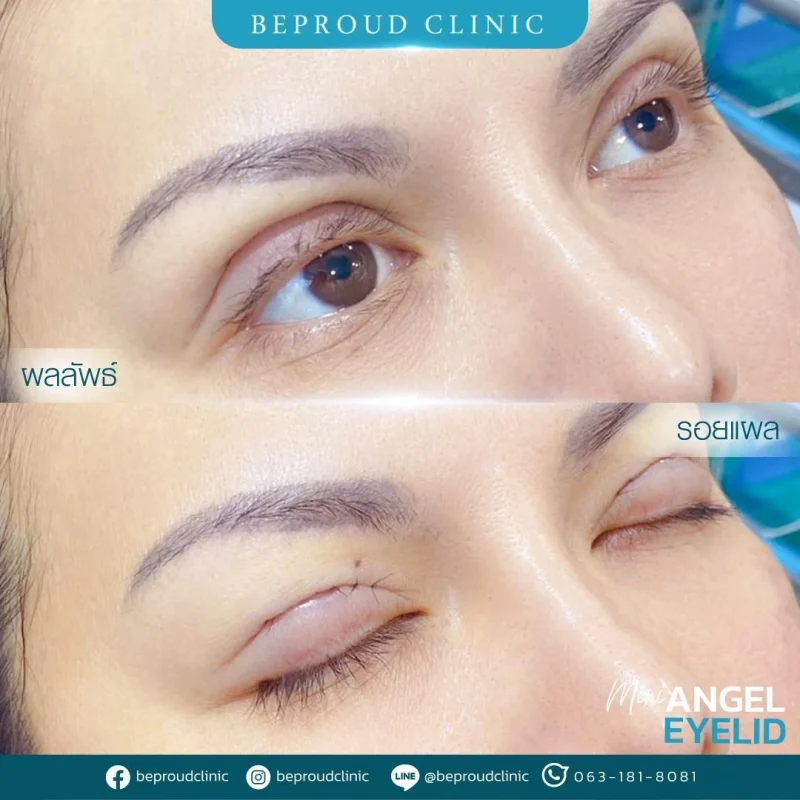 ภาพรีวิวเปรียบเทียบผลลัพธ์ ก่อนทำ-หลังทำศัลยกรรมตาสองชั้น ของเคสตัวอย่าง เทคนิคกรีดตายาว โดยอ.หมอหลิง บีพราวด์คลินิก