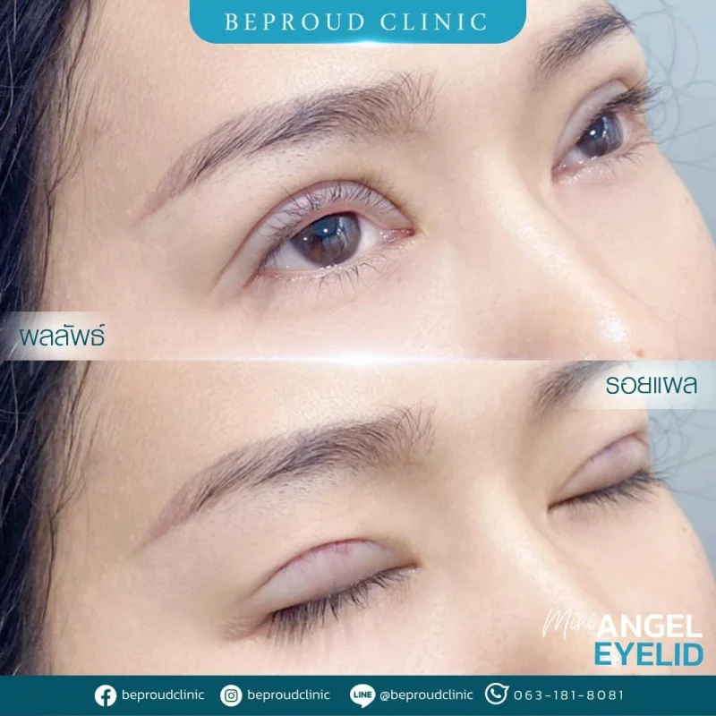 ภาพรีวิวเปรียบเทียบผลลัพธ์ ก่อนทำ-หลังทำศัลยกรรมตาสองชั้น ของเคสตัวอย่าง เทคนิคกรีดตายาว โดยอ.หมอหลิง บีพราวด์คลินิก