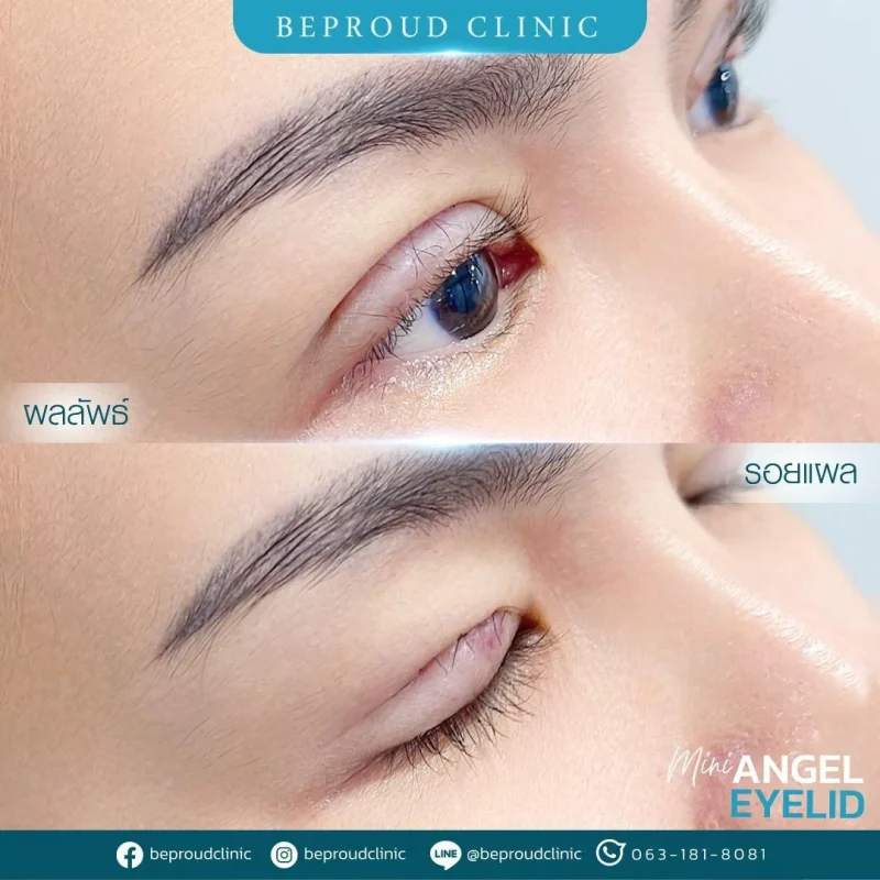 ภาพรีวิวเปรียบเทียบผลลัพธ์ ก่อนทำ-หลังทำศัลยกรรมตาสองชั้น ของเคสตัวอย่าง เทคนิคกรีดตายาว โดยอ.หมอหลิง บีพราวด์คลินิก