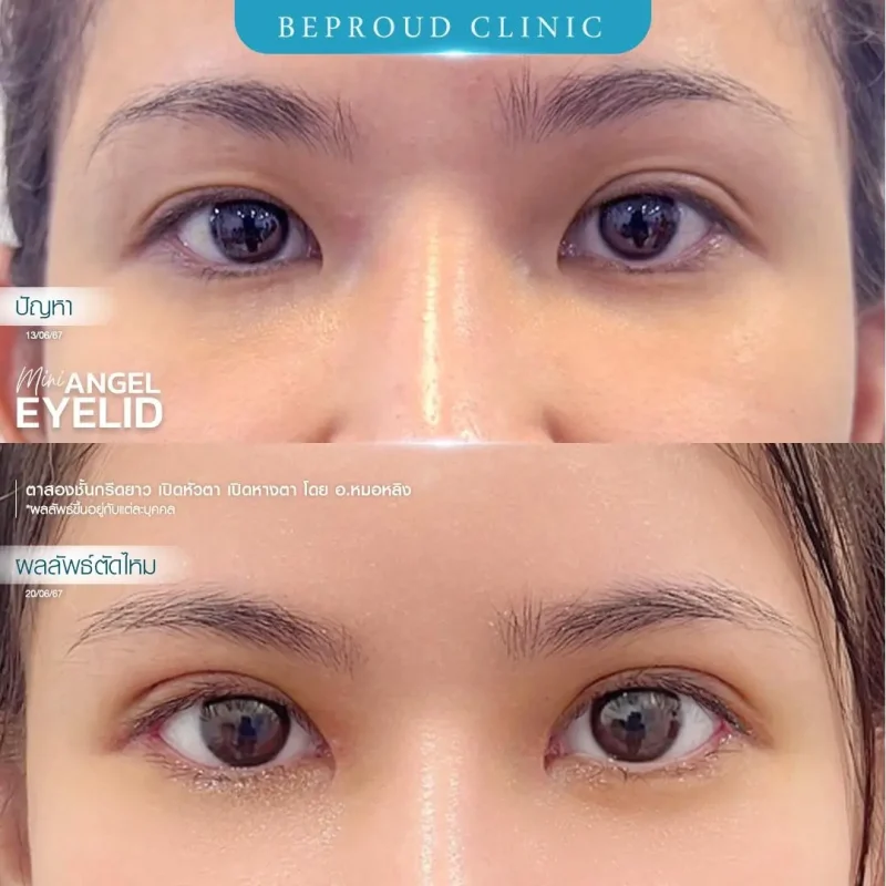 ภาพรีวิวเปรียบเทียบผลลัพธ์ ก่อนทำ-หลังทำศัลยกรรมตาสองชั้น ของเคสตัวอย่าง เทคนิคกรีดตายาว เปิดหัวตาและเปิดหางตา โดยอ.หมอหลิง บีพราวด์คลินิก