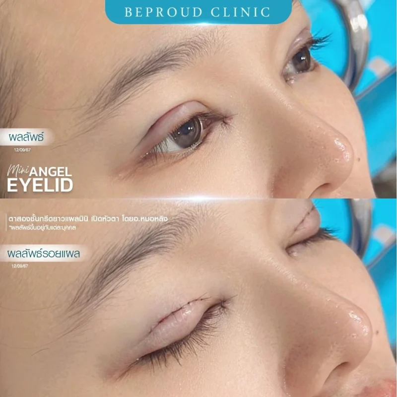 ภาพรีวิวเปรียบเทียบผลลัพธ์ ก่อนทำ-หลังทำศัลยกรรมตาสองชั้น ของเคสตัวอย่าง เทคนิคกรีดตายาวแผลมินิ และเปิดหัวตา โดยอ.หมอหลิง บีพราวด์คลินิก