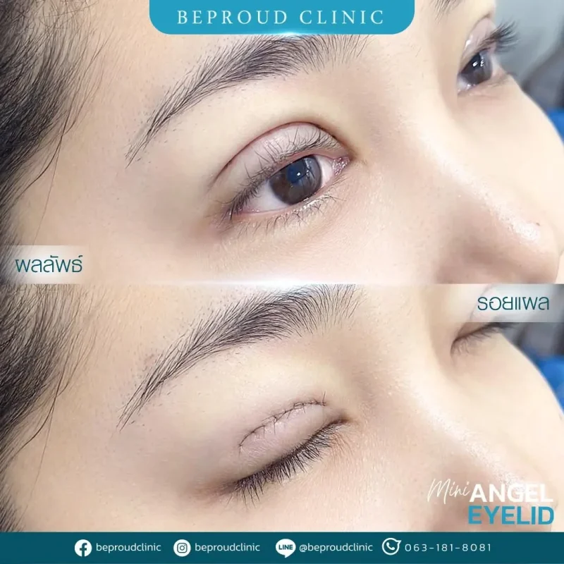 ภาพรีวิวเปรียบเทียบผลลัพธ์ ก่อนทำ-หลังทำศัลยกรรมตาสองชั้น ของเคสตัวอย่าง เทคนิคกรีดตายาว โดยอ.หมอหลิง บีพราวด์คลินิก