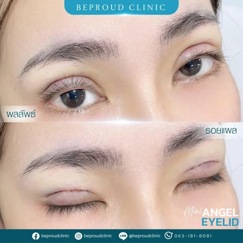 ภาพรีวิวเปรียบเทียบผลลัพธ์ ก่อนทำ-หลังทำศัลยกรรมตาสองชั้น ของเคสตัวอย่าง เทคนิคกรีดตายาว โดยอ.หมอหลิง บีพราวด์คลินิก