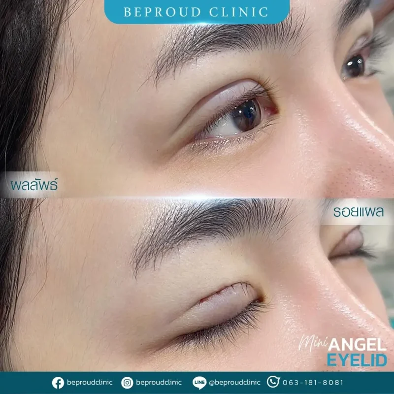 ภาพรีวิวเปรียบเทียบผลลัพธ์ ก่อนทำ-หลังทำศัลยกรรมตาสองชั้น ของเคสตัวอย่าง เทคนิคกรีดตายาว โดยอ.หมอหลิง บีพราวด์คลินิก