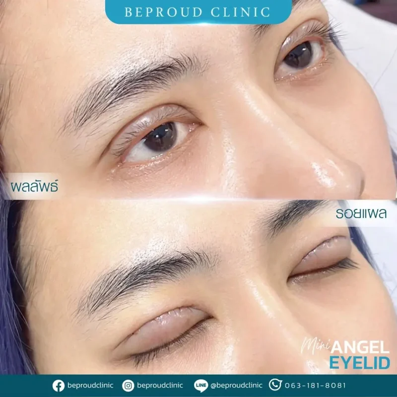 ภาพรีวิวเปรียบเทียบผลลัพธ์ ก่อนทำ-หลังทำศัลยกรรมตาสองชั้น ของเคสตัวอย่าง เทคนิคกรีดตายาว โดยอ.หมอหลิง บีพราวด์คลินิก