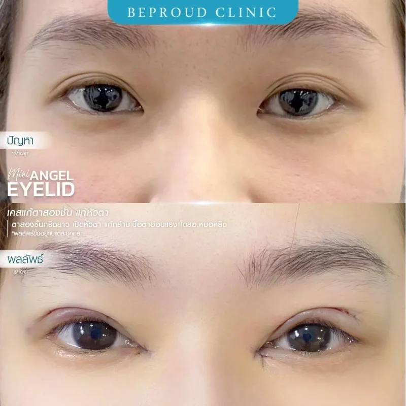 ภาพรีวิวเปรียบเทียบผลลัพธ์ ก่อนทำ-หลังทำศัลยกรรมแก้ตาสองชั้น แก้หัวตา ของเคสตัวอย่าง เทคนิคกรีดตายาว เปิดหัวตา แก้กล้ามเนื้อตาอ่อนแรง โดยอ.หมอหลิง บีพราวด์คลินิก