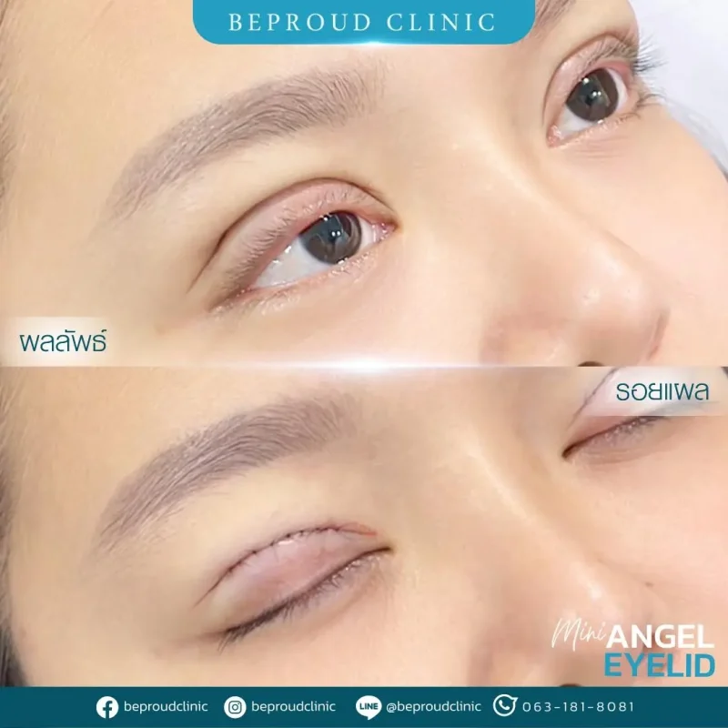 ภาพรีวิวเปรียบเทียบผลลัพธ์ ก่อนทำ-หลังทำศัลยกรรมตาสองชั้น ของเคสตัวอย่าง เทคนิคกรีดตายาว โดยอ.หมอหลิง บีพราวด์คลินิก