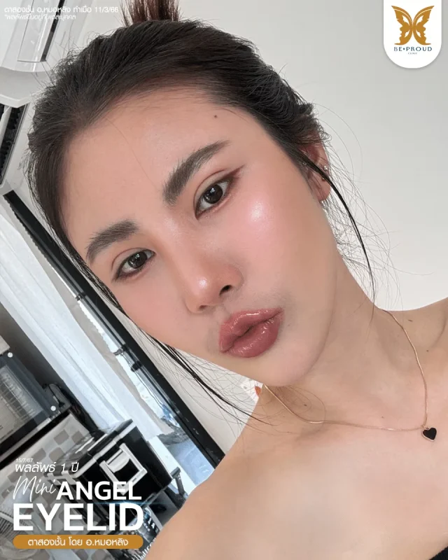 ภาพรีวิวคนสวย ตาสองชั้นกรีดยาวแผลมินิ โดย อ.หมอหลิง (พญ.กัญญ์ชิสา) บีพราวด์คลินิก แสดงผลลัพธ์ ชั้นตาสวยคมชัด ดวงตาดูสดใส