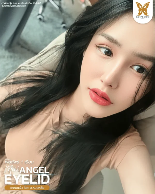 ภาพรีวิวคนสวย ตาสองชั้นกรีดยาวแผลมินิ โดย อ.หมอหลิง (พญ.กัญญ์ชิสา) บีพราวด์คลินิก แสดงผลลัพธ์ ชั้นตาสวยคมชัด ดวงตาดูสดใส