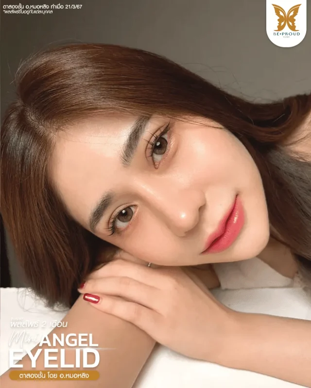 ภาพรีวิวคนสวย ตาสองชั้นกรีดยาวแผลมินิ โดย อ.หมอหลิง (พญ.กัญญ์ชิสา) บีพราวด์คลินิก แสดงผลลัพธ์ ชั้นตาสวยคมชัด ดวงตาดูสดใส