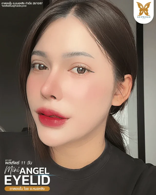 ภาพรีวิวคนสวย ตาสองชั้นกรีดยาวแผลมินิ โดย อ.หมอหลิง (พญ.กัญญ์ชิสา) บีพราวด์คลินิก แสดงผลลัพธ์ ชั้นตาสวยคมชัด ดวงตาดูสดใส