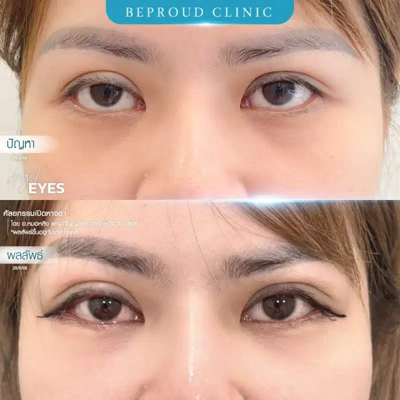 ภาพเปรียบเทียบ Before & After ศัลยกรรมเปิดหางตา ผลลัพธ์ดวงตาที่เรียวยาวและเปิดกว้างขึ้นอย่างเห็นได้ชัด