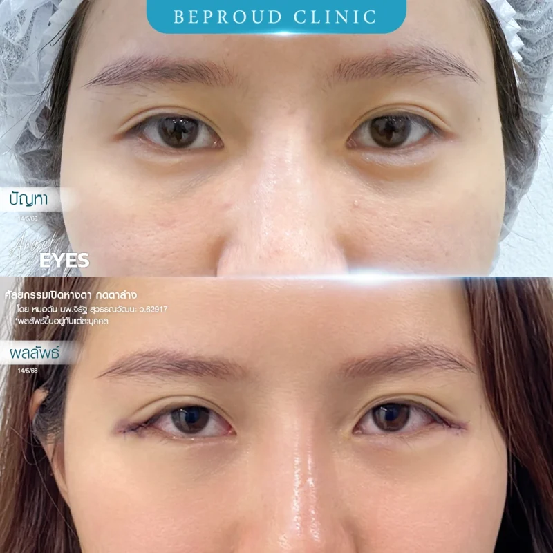 ภาพเปรียบเทียบ Before & After ศัลยกรรมเปิดหางตา ผลลัพธ์ดวงตาที่เรียวยาวและเปิดกว้างขึ้นอย่างเห็นได้ชัด
