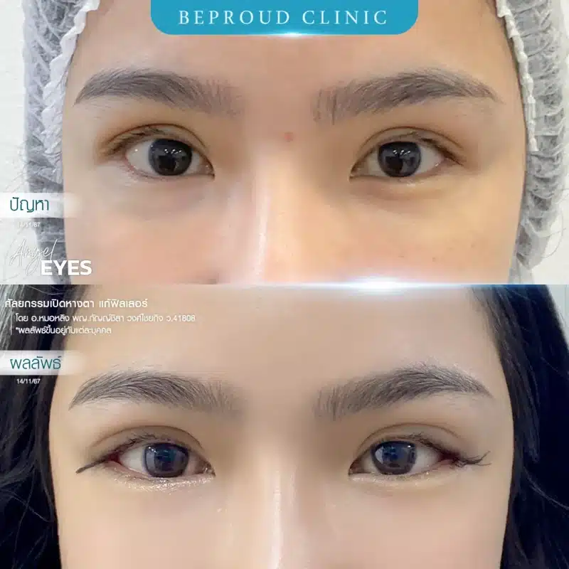 ภาพเปรียบเทียบ Before & After ศัลยกรรมเปิดหางตา ผลลัพธ์ดวงตาที่เรียวยาวและเปิดกว้างขึ้นอย่างเห็นได้ชัด