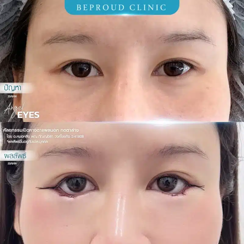 ภาพเปรียบเทียบ Before & After ศัลยกรรมเปิดหางตาพร้อมกดตาล่าง (Angel Eyes) แสดงให้เห็นดวงตาที่เรียวยาวและกลมโตขึ้นอย่างชัดเจน