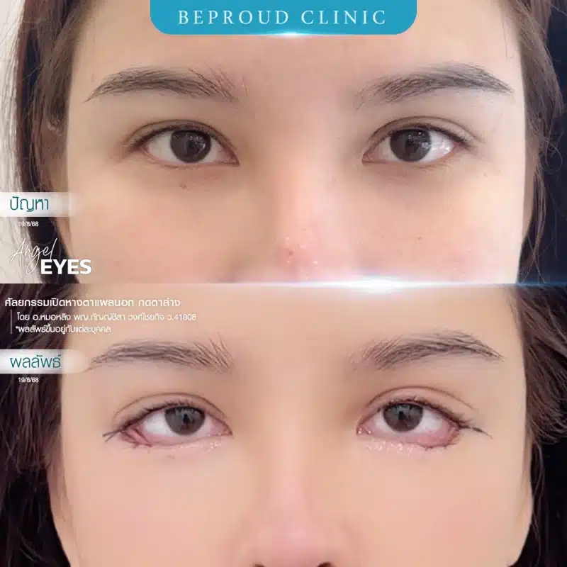 ภาพเปรียบเทียบ Before & After ศัลยกรรมเปิดหางตาพร้อมกดตาล่าง (Angel Eyes) แสดงให้เห็นดวงตาที่เรียวยาวและกลมโตขึ้นอย่างชัดเจน