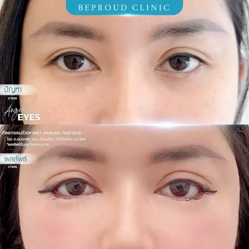 ภาพเปรียบเทียบ Before & After ศัลยกรรมเปิดหางตาพร้อมกดตาล่าง (Angel Eyes) แสดงให้เห็นดวงตาที่เรียวยาวและกลมโตขึ้นอย่างชัดเจน