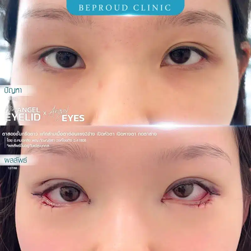 ภาพเปรียบเทียบ Before & After ศัลยกรรมเปิดหางตาพร้อมกดตาล่าง (Angel Eyes) แสดงให้เห็นดวงตาที่เรียวยาวและกลมโตขึ้นอย่างชัดเจน