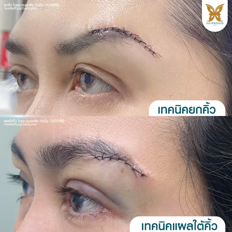 ภาพเปรียบเทียบเทคนิคยกคิ้ว (Brow Lift) กับเทคนิคแผลใต้คิ้ว (Sub-Brow Lift) หลังผ่าตัด แสดงรอยเย็บและตำแหน่งที่แตกต่างกัน แก้ปัญหาหนังตาหย่อนและคิ้วตก