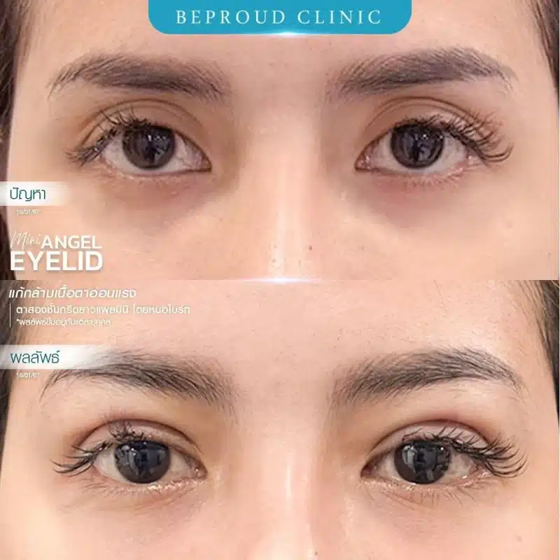 ภาพรีวิวเปรียบเทียบ ก่อน-หลัง ทำตาสองชั้น แก้ไขกล้ามเนื้อตาอ่อนแรง แสดงให้เห็นดวงตาที่เปิดเต็มที่ ตาดำชัดเจนขึ้น และชั้นตาที่สวยงาม