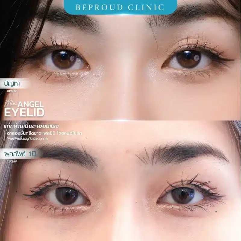 ภาพรีวิวเปรียบเทียบ ก่อน-หลัง ทำตาสองชั้น แก้ไขกล้ามเนื้อตาอ่อนแรง แสดงให้เห็นดวงตาที่เปิดเต็มที่ ตาดำชัดเจนขึ้น และชั้นตาที่สวยงาม