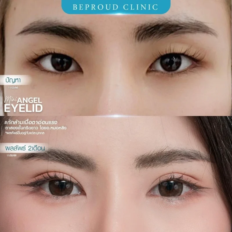 ภาพรีวิวเปรียบเทียบ ก่อน-หลัง ทำตาสองชั้น แก้ไขกล้ามเนื้อตาอ่อนแรง แสดงให้เห็นดวงตาที่เปิดเต็มที่ ตาดำชัดเจนขึ้น และชั้นตาที่สวยงาม