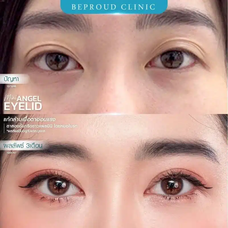ภาพรีวิวเปรียบเทียบ ก่อน-หลัง ทำตาสองชั้น แก้ไขกล้ามเนื้อตาอ่อนแรง แสดงให้เห็นดวงตาที่เปิดเต็มที่ ตาดำชัดเจนขึ้น และชั้นตาที่สวยงาม