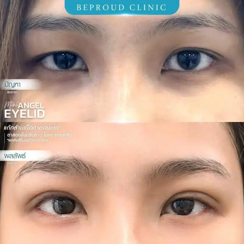 ภาพรีวิวเปรียบเทียบ ก่อน-หลัง ทำตาสองชั้น แก้ไขกล้ามเนื้อตาอ่อนแรง แสดงให้เห็นดวงตาที่เปิดเต็มที่ ตาดำชัดเจนขึ้น และชั้นตาที่สวยงาม