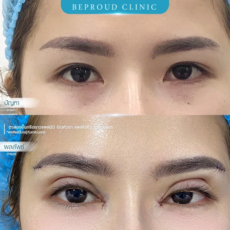 ภาพเปรียบเทียบก่อน-หลังทำศัลยกรรมแผลใต้คิ้ว (Sub-Brow Lift) ร่วมกับตาสองชั้น โดย Beproud Clinic