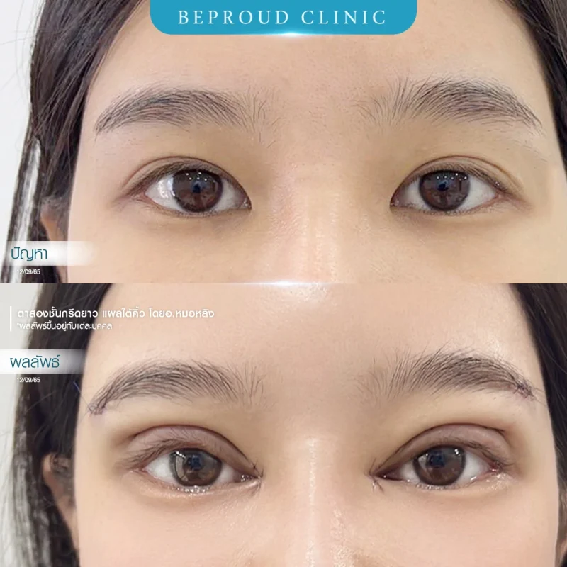 ภาพเปรียบเทียบก่อน-หลังทำศัลยกรรมแผลใต้คิ้ว (Sub-Brow Lift) ร่วมกับตาสองชั้น โดย Beproud Clinic