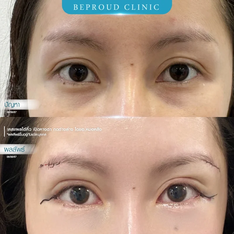 ภาพเปรียบเทียบก่อน-หลังทำศัลยกรรมแผลใต้คิ้ว (Sub-Brow Lift) ร่วมกับตาสองชั้น โดย Beproud Clinic