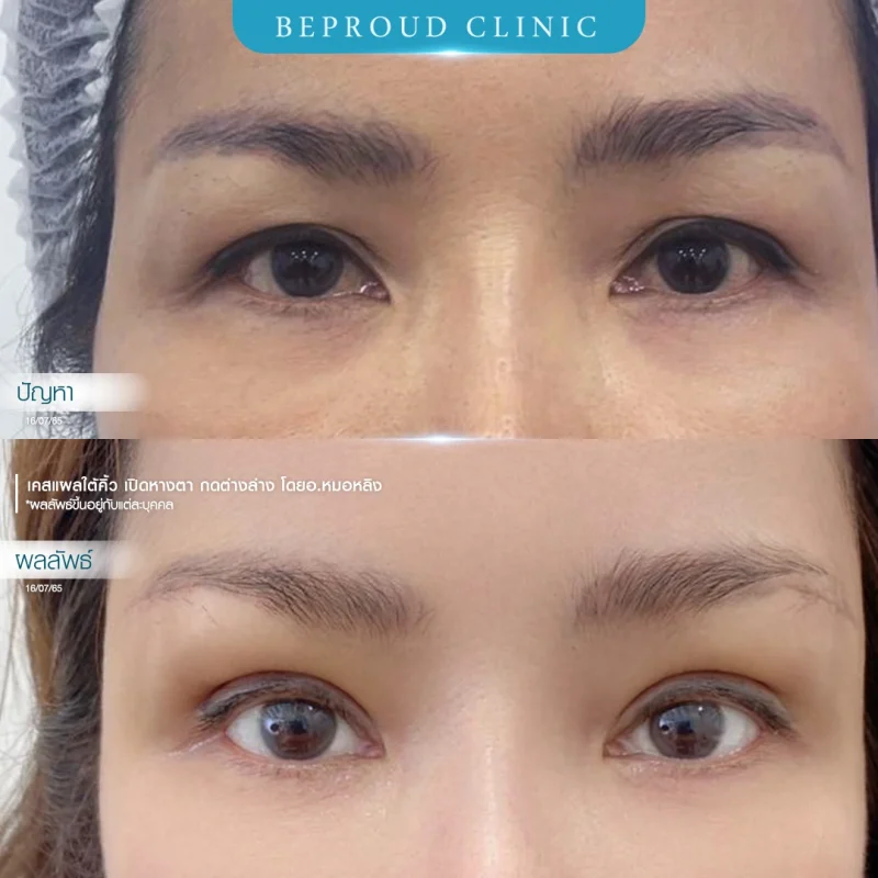 ภาพเปรียบเทียบก่อน-หลังทำศัลยกรรมแผลใต้คิ้ว (Sub-Brow Lift) ร่วมกับตาสองชั้น โดย Beproud Clinic