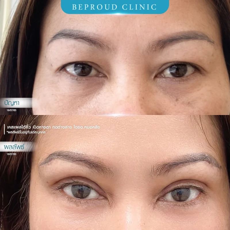 ภาพเปรียบเทียบก่อน-หลังทำศัลยกรรมแผลใต้คิ้ว (Sub-Brow Lift) ร่วมกับตาสองชั้น โดย Beproud Clinic