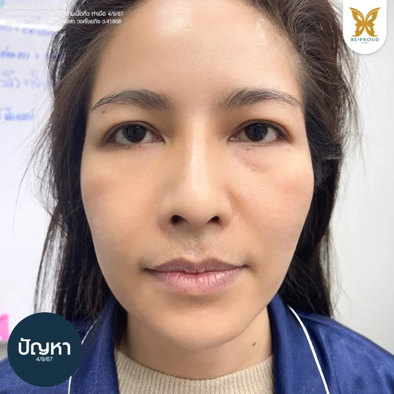 ภาพใบหน้าก่อนทำศัลยกรรมแผลใต้คิ้ว (Sub-Brow Lift) แสดงปัญหาหนังตาหย่อนคล้อยและตาดูเหนื่อยล้า ที่ Beproud Clinic