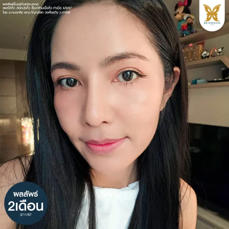 ภาพใบหน้าหลังทำศัลยกรรมแผลใต้คิ้ว (Sub-Brow Lift) แสดงผลลัพธ์หลังทำ2เดือน แก้ปัญหาหนังตาหย่อนคล้อยและตาดูเหนื่อยล้า ที่ Beproud Clinic