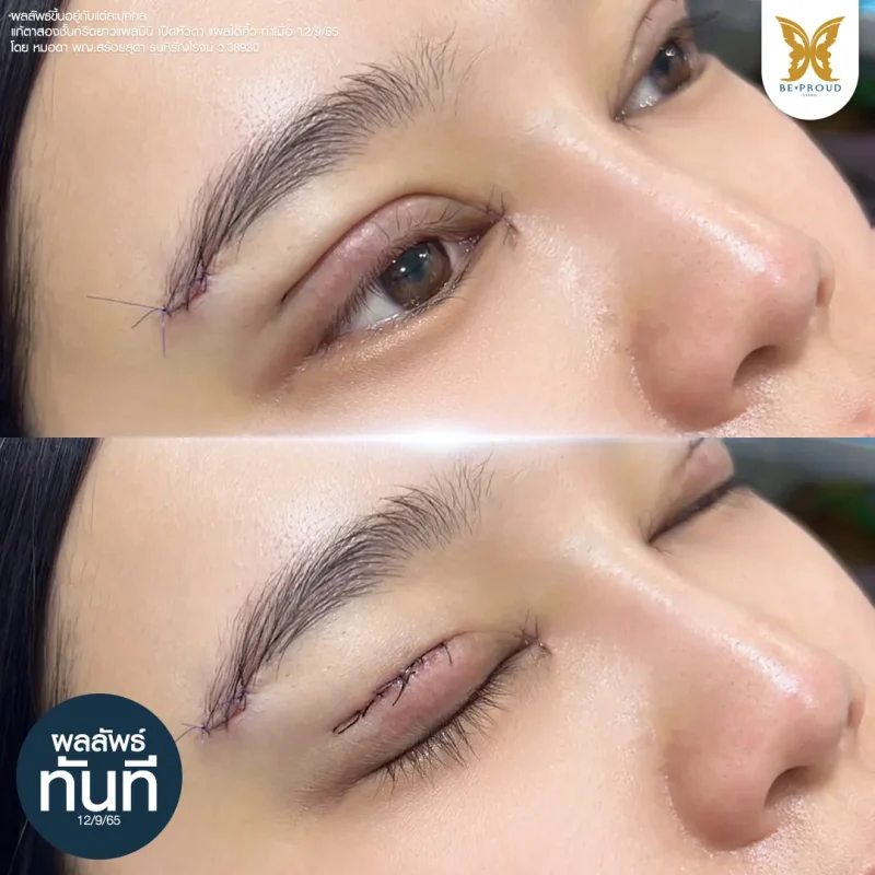 ภาพใบหน้าคุณแพท ก่อนทำศัลยกรรมแผลใต้คิ้ว/ยกคิ้ว แสดงผลลัพธ์ ทันทีหลังทำ แก้ปัญหาหนังตาหย่อนคล้อย คิ้วตกเล็กน้อย และความไม่สมดุลของดวงตา