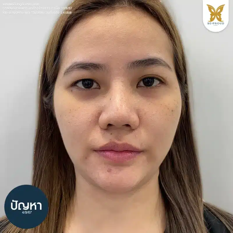 ภาพเปรียบเทียบเทคนิคแผลยกคิ้ว กับเทคนิคแผลใต้คิ้ว (Sub-Brow Lift) แสดงตำแหน่งแผลที่ใต้ท้องคิ้ว เพื่อเก็บหนังตาหย่อน ที่ Beproud Clinic