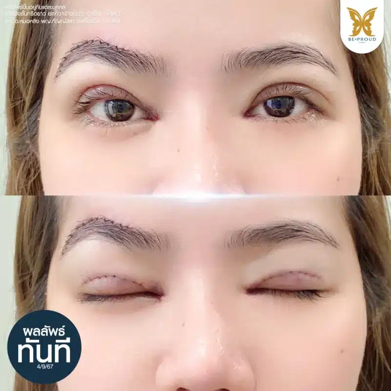 ภาพเปรียบเทียบเทคนิคแผลยกคิ้ว (เหนือคิ้ว) กับเทคนิคแผลใต้คิ้ว (Sub-Brow Lift) แสดงรอยเย็บใต้ท้องคิ้ว สำหรับแก้ไขหนังตาหย่อน ที่ Beproud Clinic