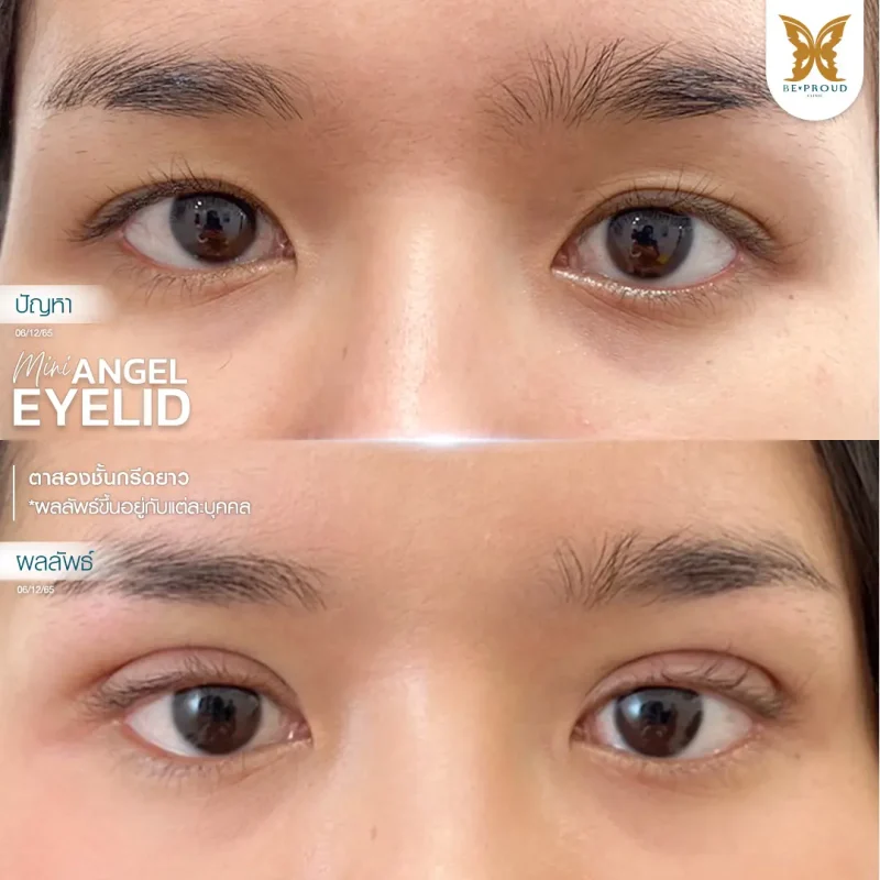 ภาพรีวิวเปรียบเทียบผลลัพธ์ ก่อนทำ-หลังทำศัลยกรรมตาสองชั้น ของเคสตัวอย่าง เทคนิคกรีดตายาว โดยหมอจู บีพราวด์คลินิก